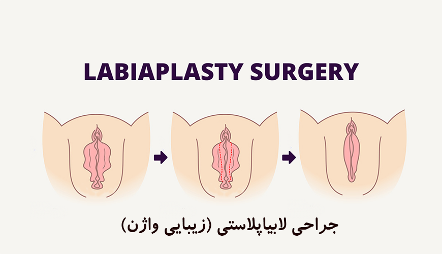 جراحی لابیاپلاستی در شیراز بنر