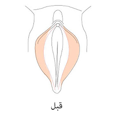 جراحی لابیاپلاستی قبل