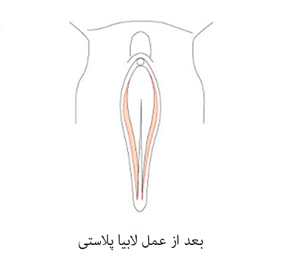 جراحی لابیاپلاستی بعد