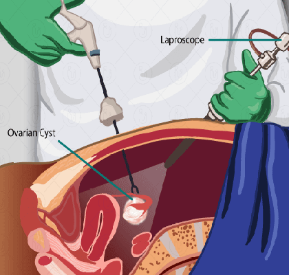 درمان کیست تخمدان اسلایدر1