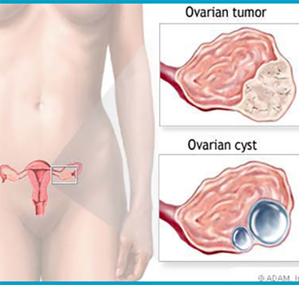 درمان کیست تخمدان اسلایدر2