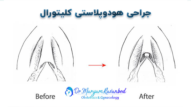 جراحی زیبایی واژن هودوپلاستی