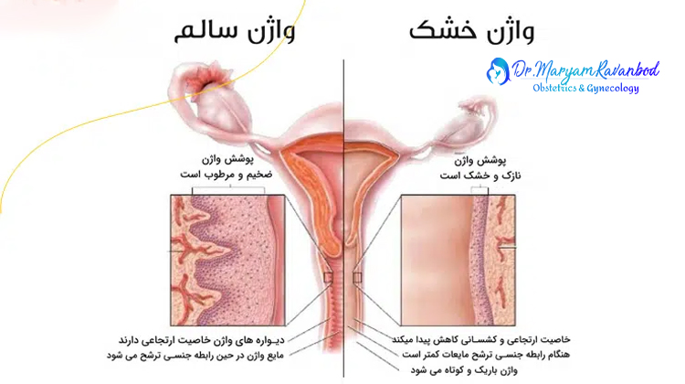 درمان خشکی واژن