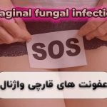 درمان عفونت های قارچی واژینال در شیراز