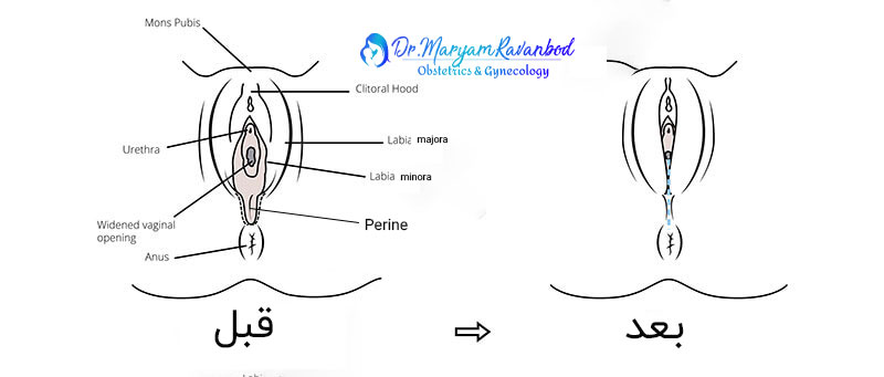 پرینوپلاستی در شیراز