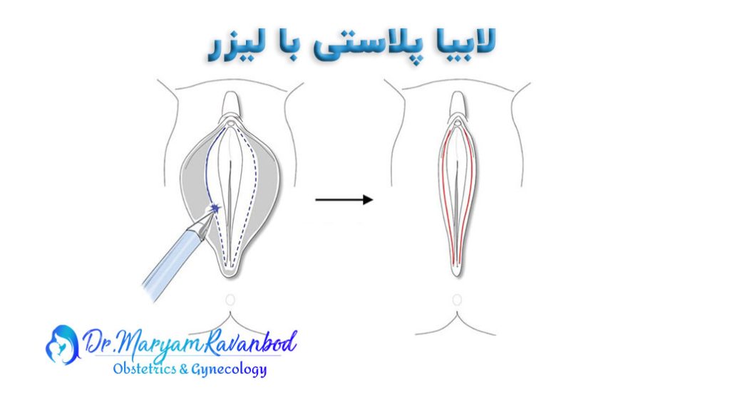 لابیاپلاستی